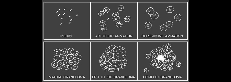 Stages of Granuloma Formation