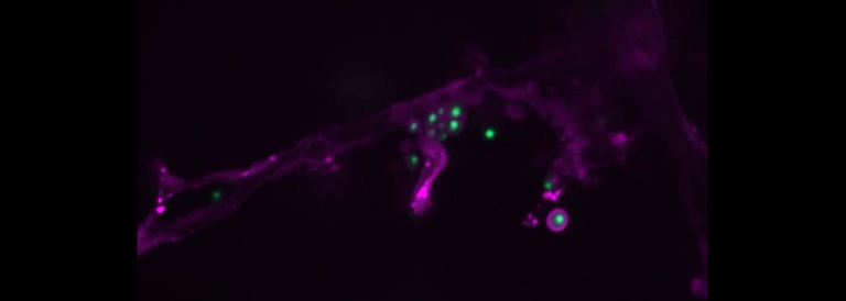 Endothelial destruction during brain dissemination